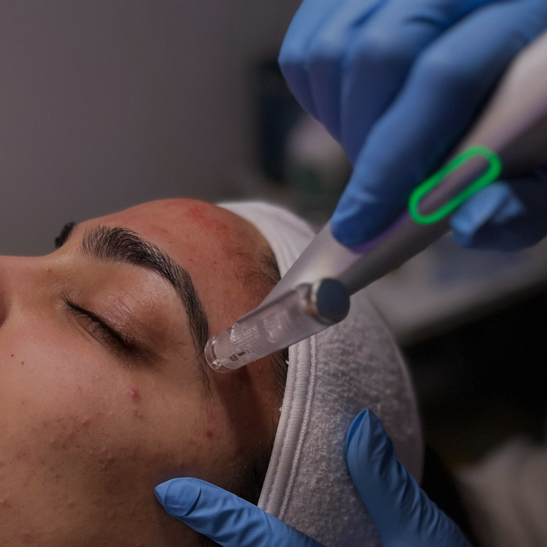 microneedling