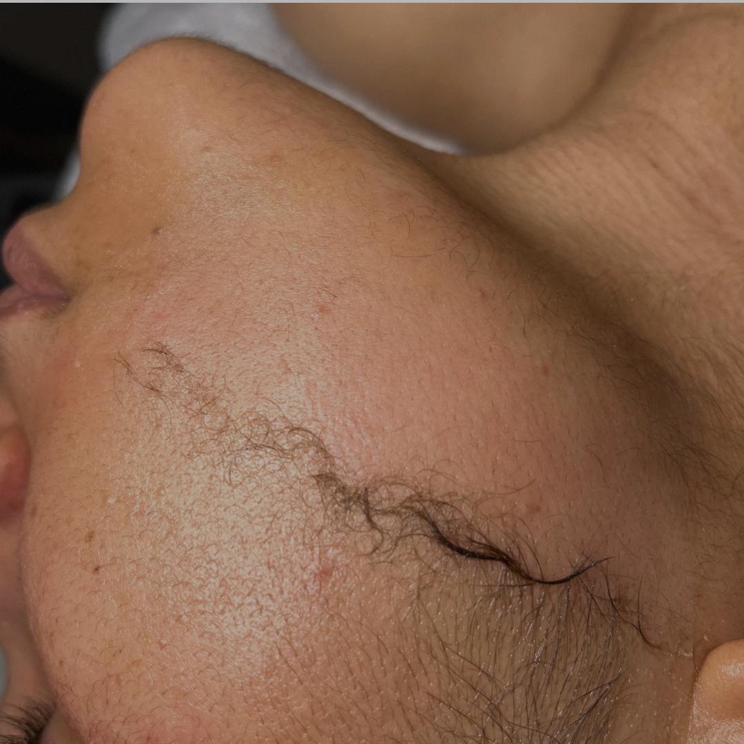 Dermaplaning facial