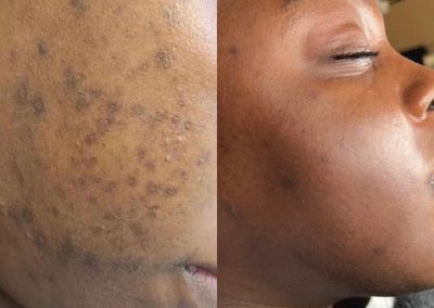 Zena Algae Peel Before And After