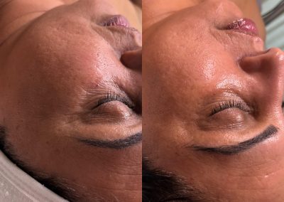 Microneedling and DMK