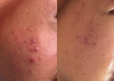 Microneedling and chemical peel