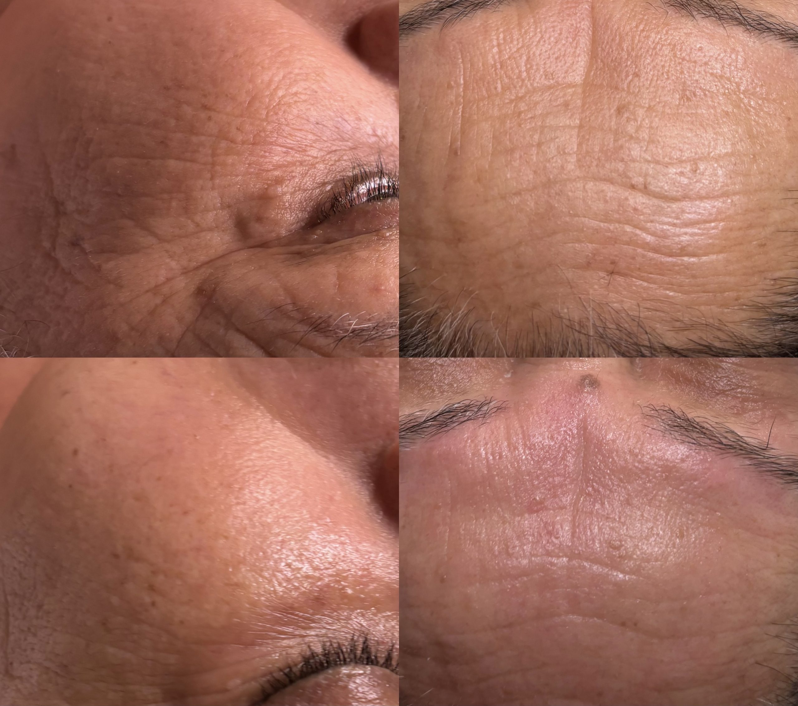 Anti aging chemical peel