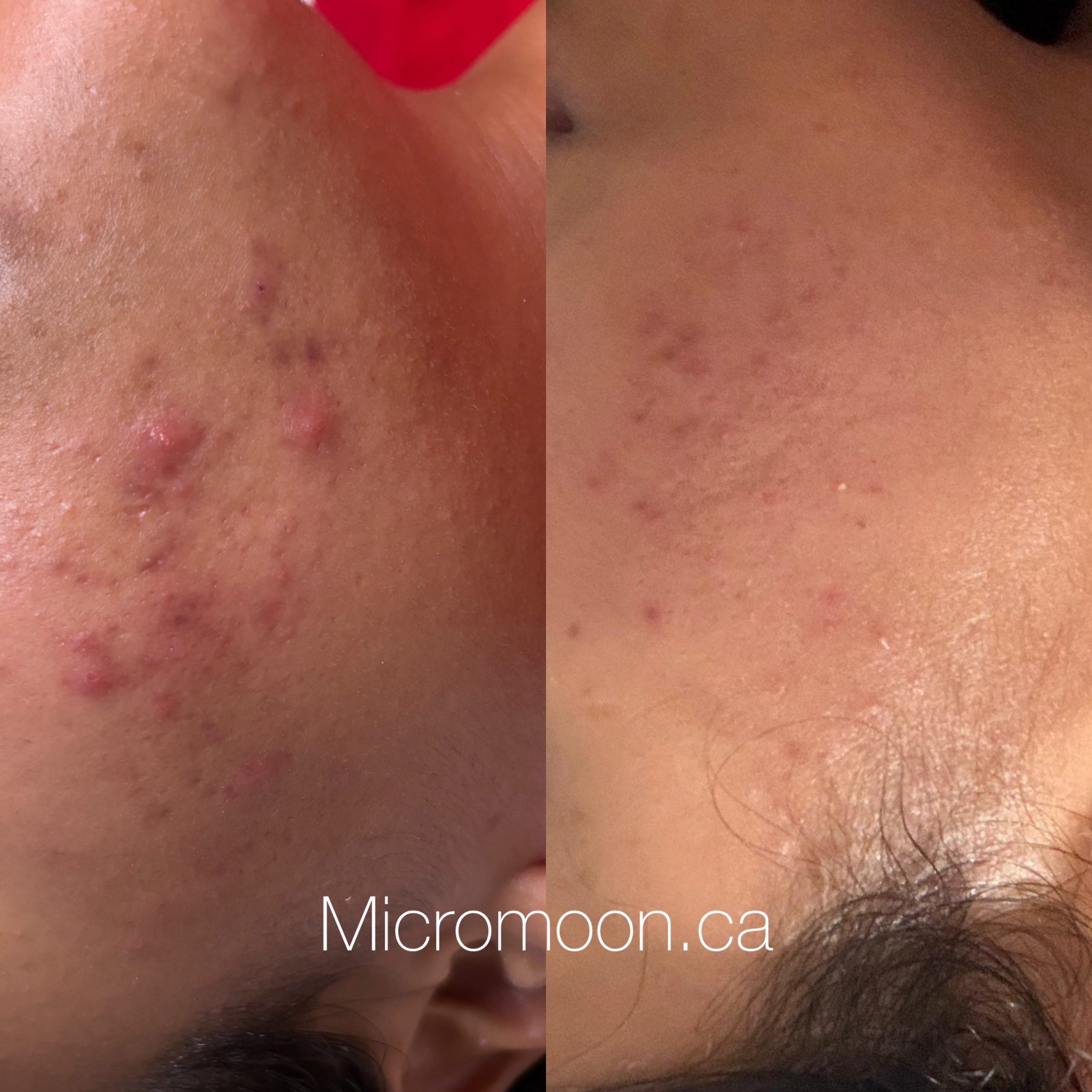 Fall Facials for your skincare type - Vancouver Esthetician Micromoon Skin Studio