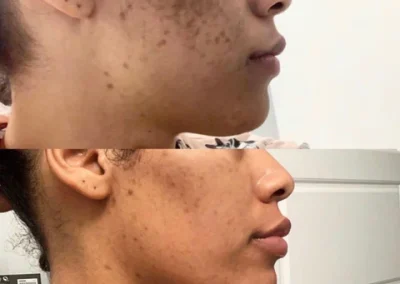Zena Peel for Melasma