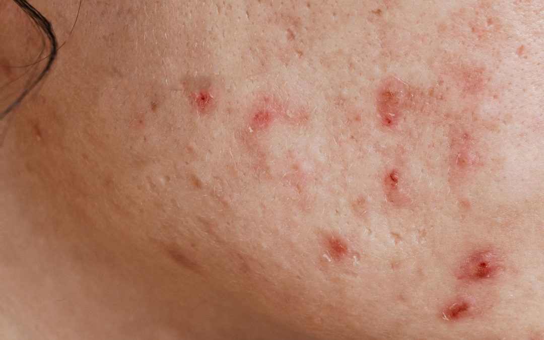 Skin Discoloration Decoded: PIH vs. PIE, Root Causes, and Tailored Care for All Skin Tones