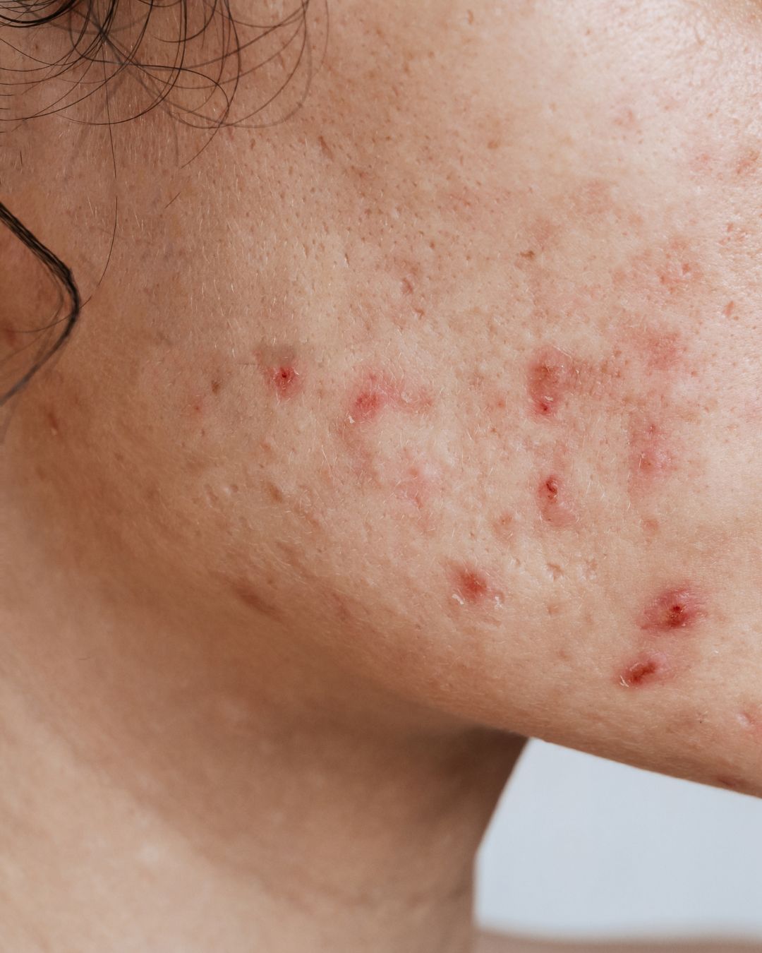 Post Inflammatory Erythema
