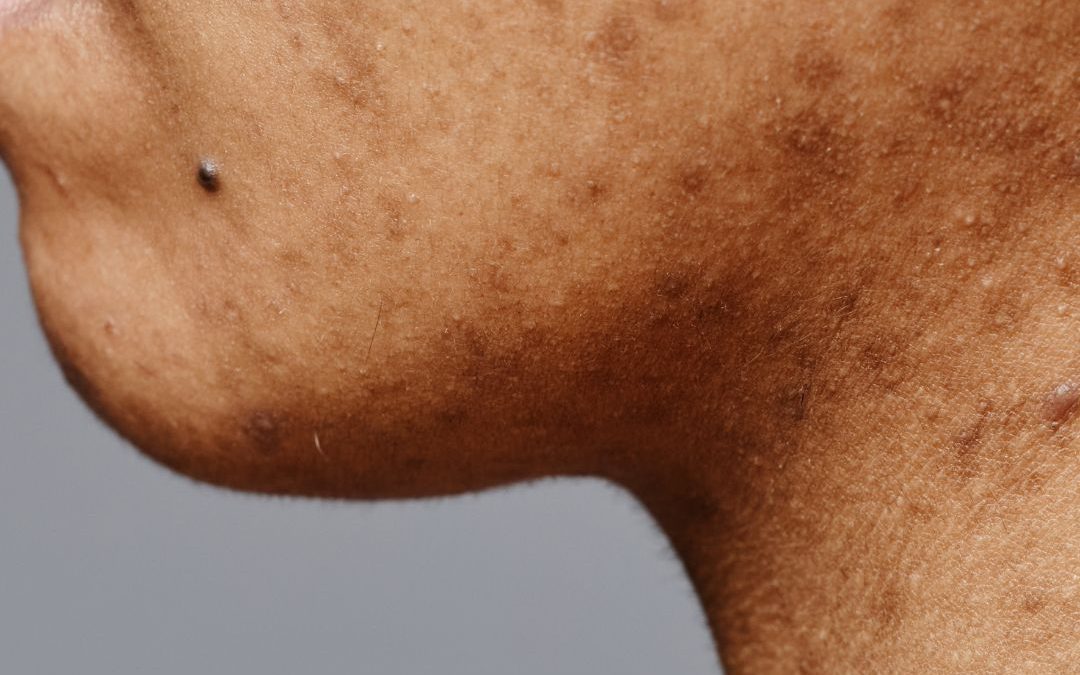 Chemical Peels in Surrey & Langley: Are They Right for Your Skin Type?