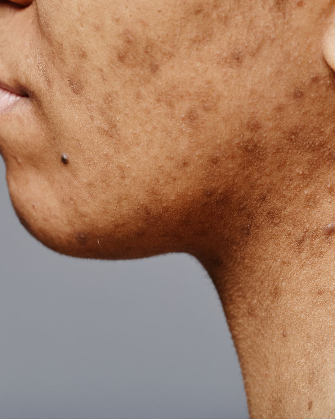 Post Inflammatory Acne Skin