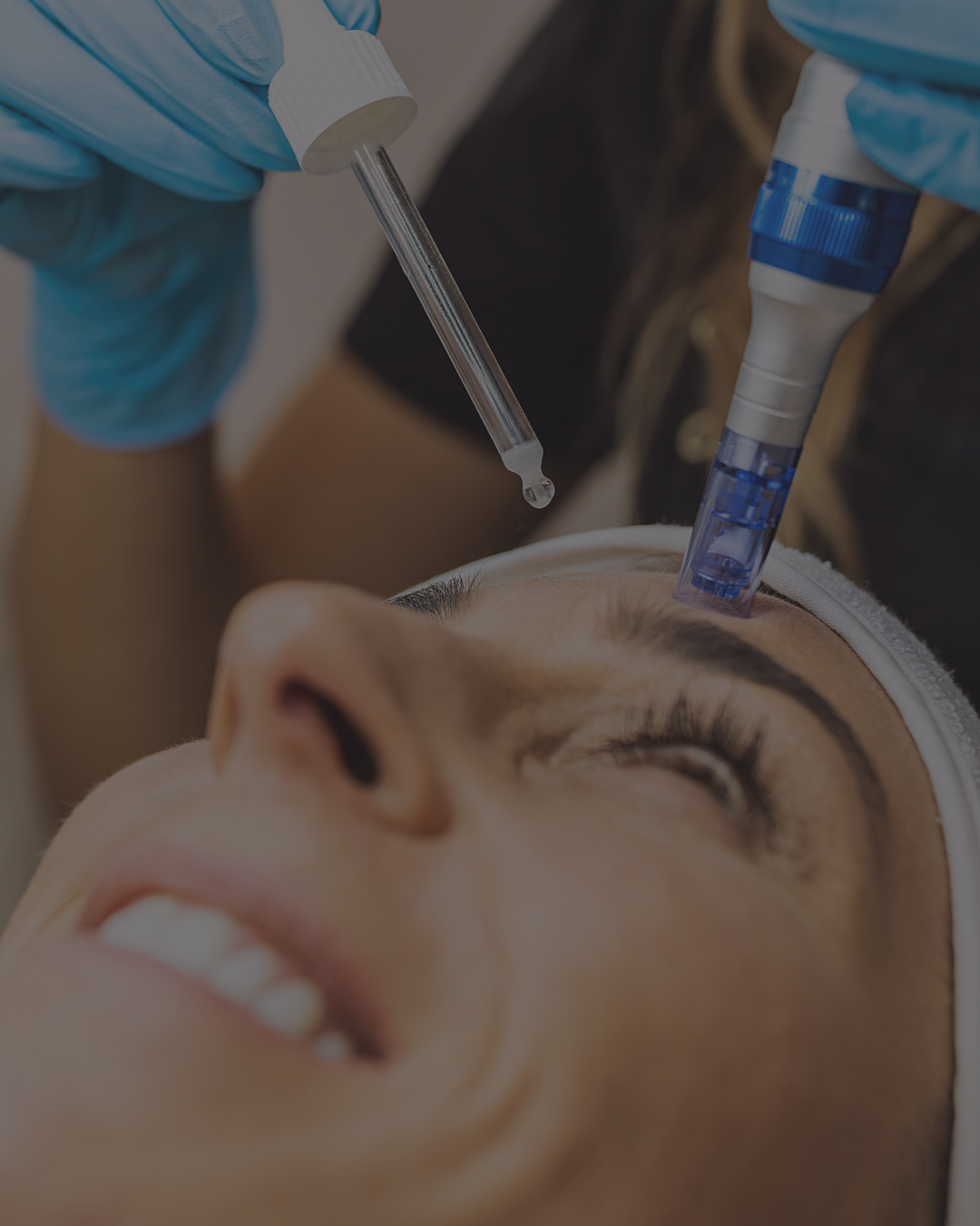 Microneedling treatment