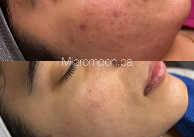 Acne transformation