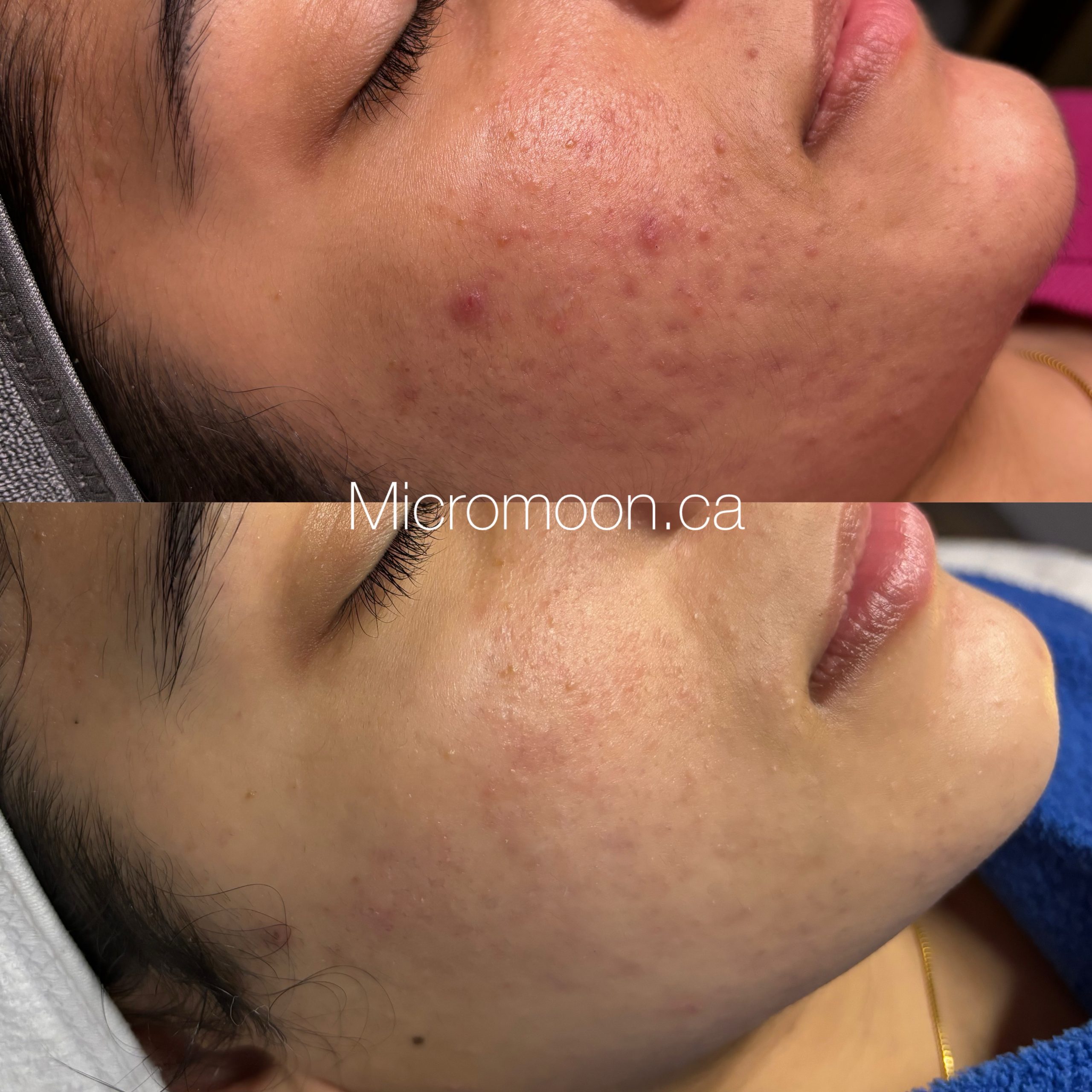 Acne transformation