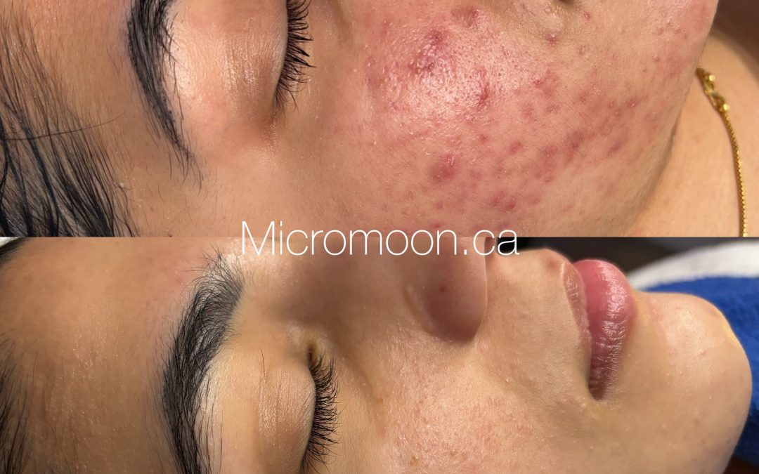 PCOS, Emotional Trauma and Blood Sugar: The Overlooked Connection Affecting Your Skin