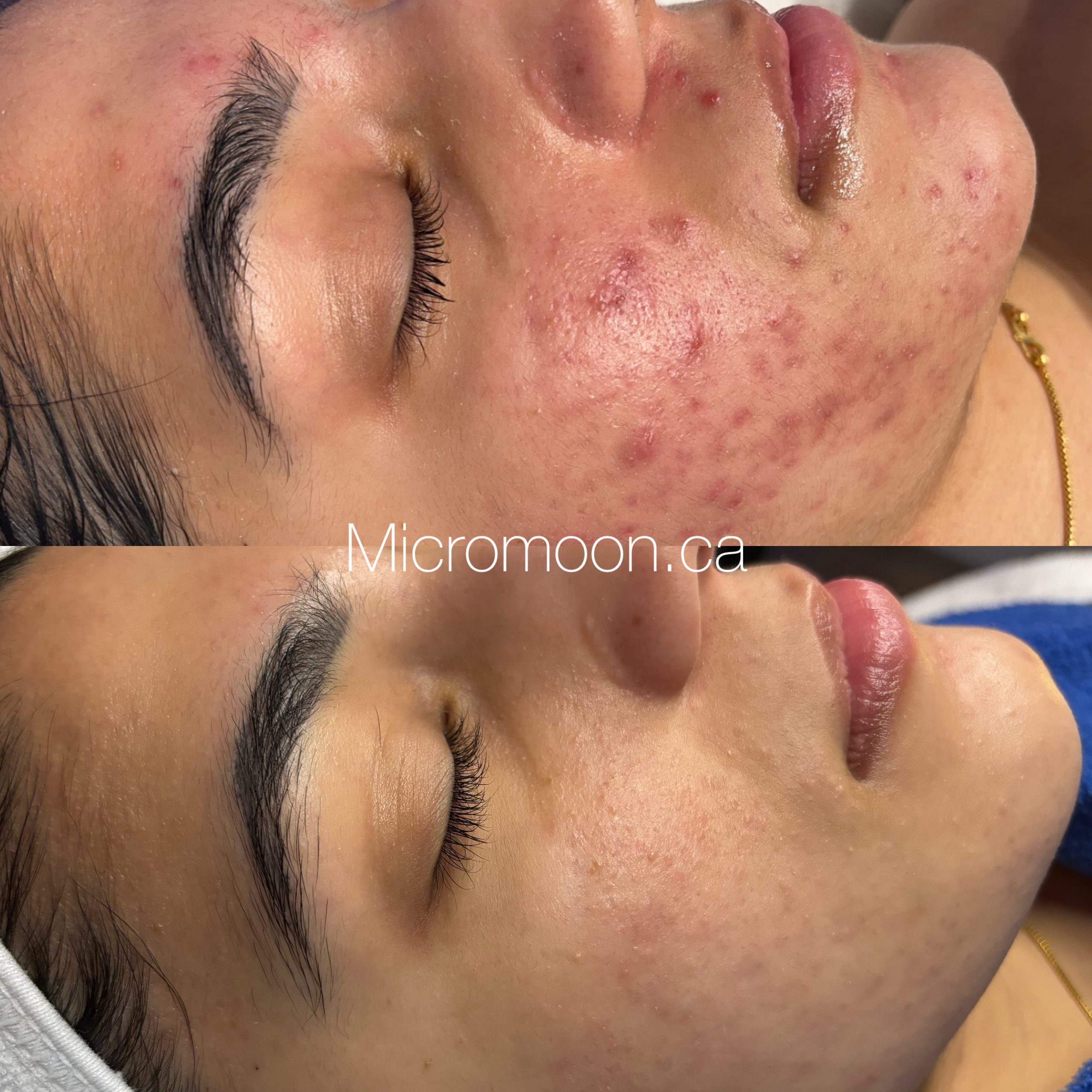 Vancouver Acne Clinic before and after