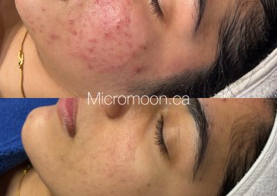 Microneedling Before and Afetr
