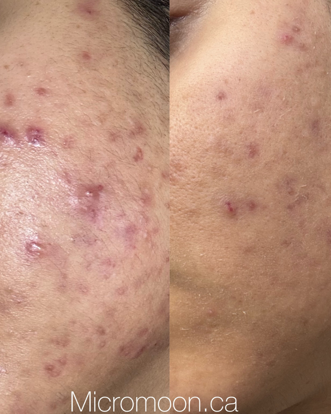 Acne_Befora And After_1080_x1350 Acne before and after