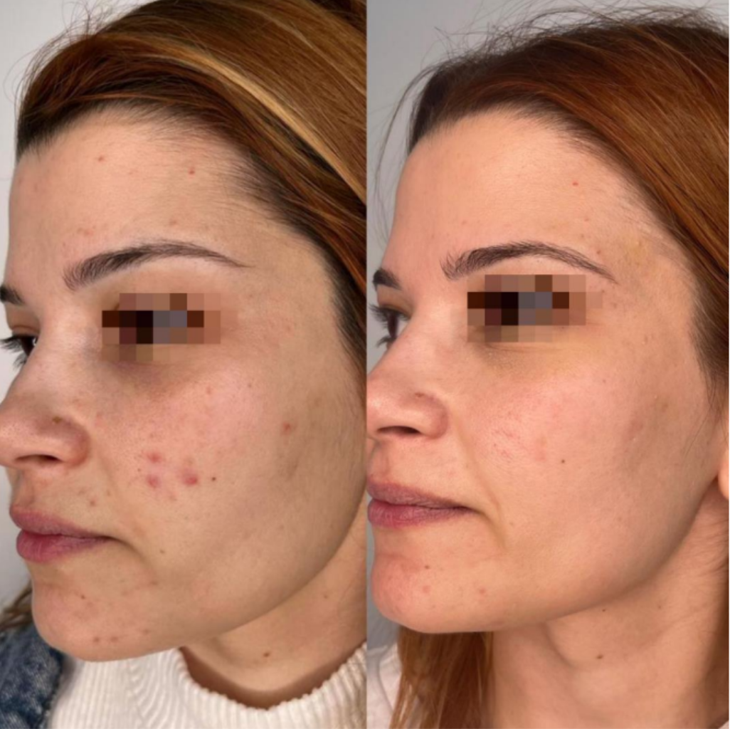Microneedling Exosomes_For Ace Scarring_1026_x_1024 Microneedling with Exosomes for Acne Scarring