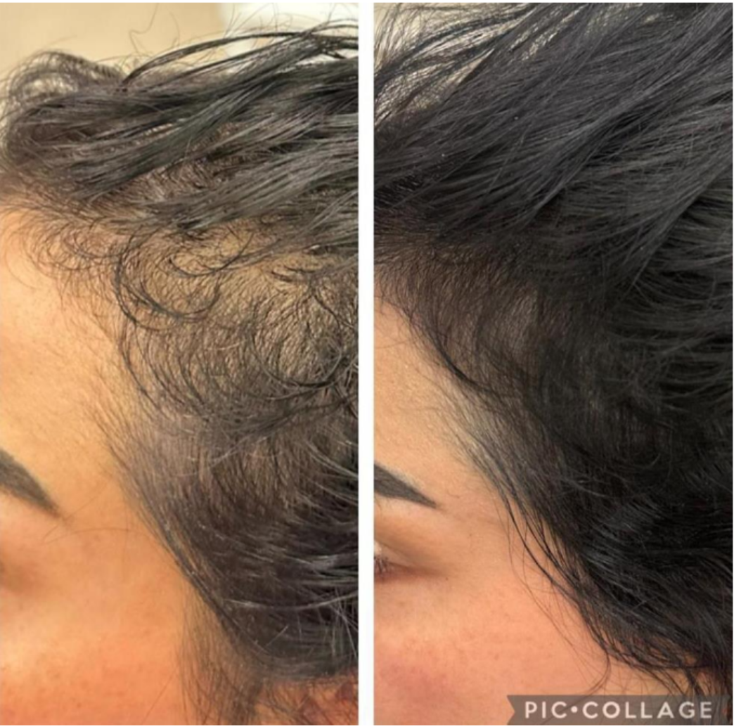 Hair Growth_With Purasomes Exosomes_1044_X_1034 Purasomes Hair Growth Treatment