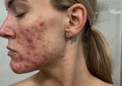 Acne client's before picture at Micromoon