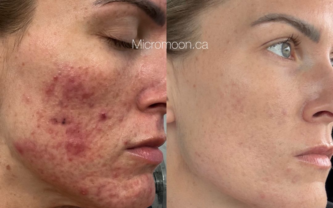 From Painful Breakouts to Radiant Skin: A 5-Month Acne Transformation with Micromoon Skin Studio