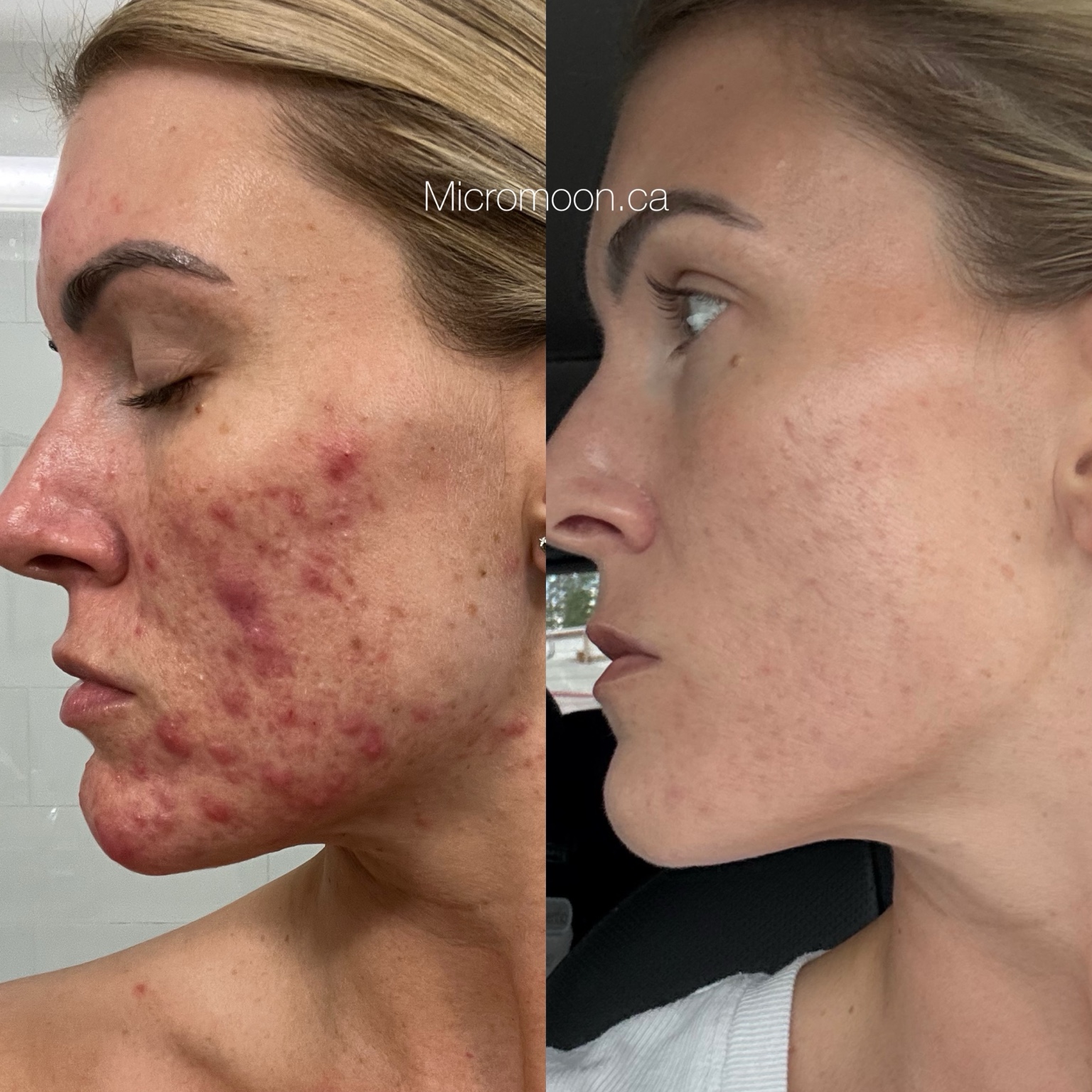 Before and after 5-month acne treatment transformation at Micromoon Skin Studio, Cloverdale, Surrey BC.