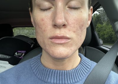 Acne Client After Picture at Micromoon