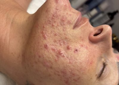 Acne client transformation at Micromoon