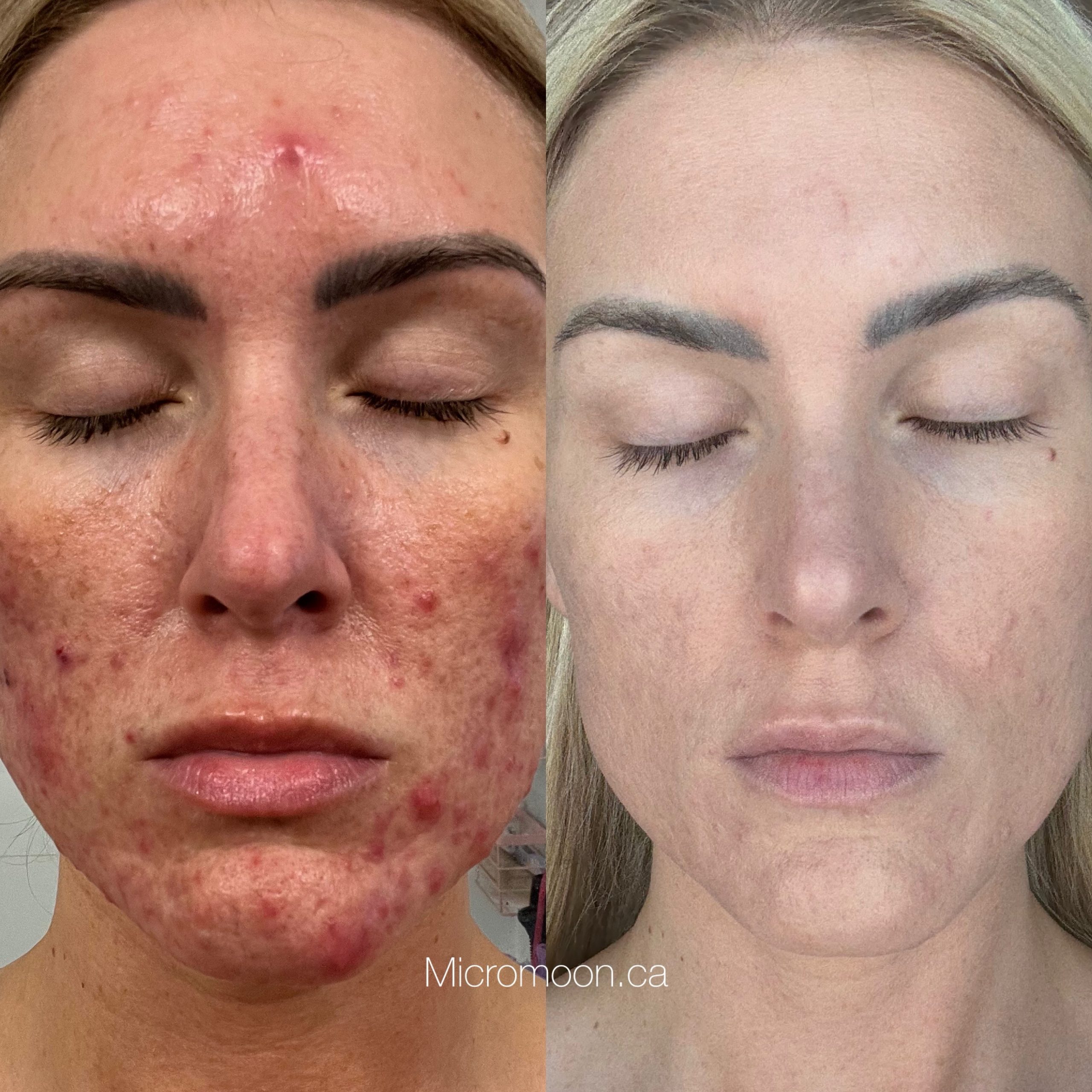 Acne Before And After_At Micromoon Surrey_2560_x_2560 Acne before and after at Micromoon