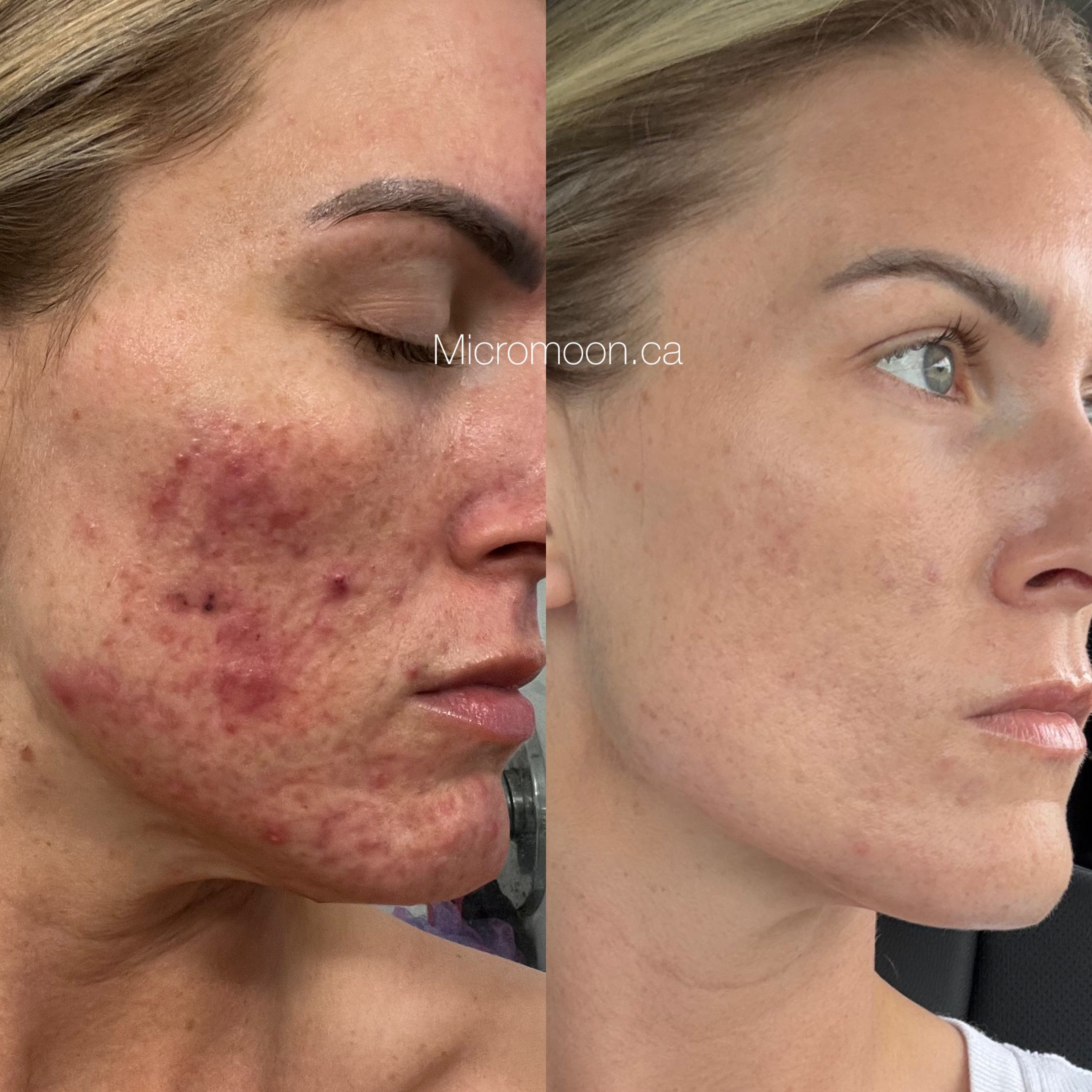 Acne facial Surrey BC Micromoon Skin Studio Cloverdale