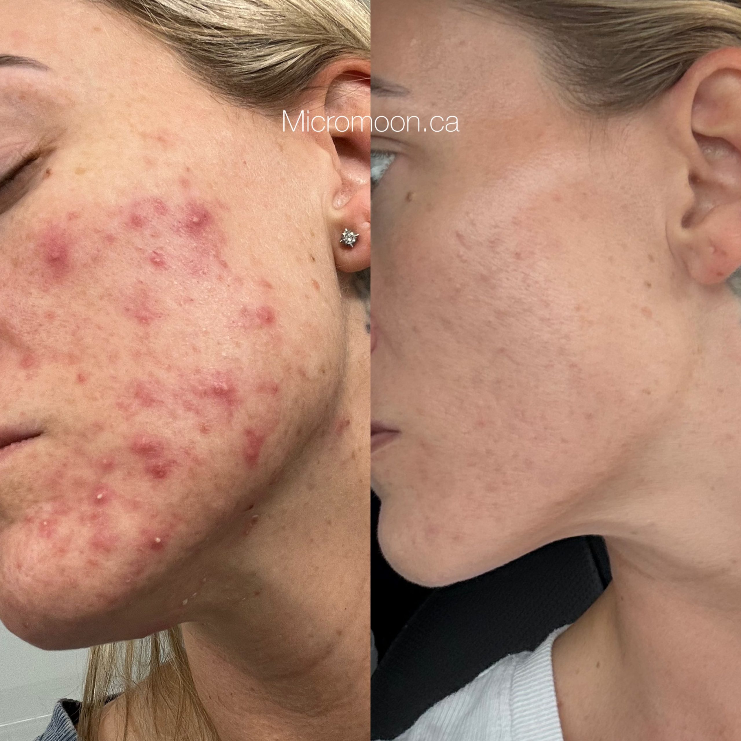 PCOS emotional trauma blood sugar skin connection Micromoon Surrey BC